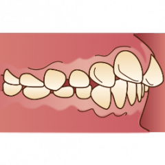 上顎前突（上の前歯が突出している状態）