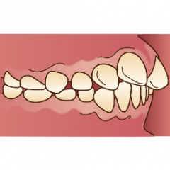 混合歯列期の治療 | 松本矯正歯科