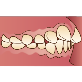 上顎前突（上の前歯が突出している状態）