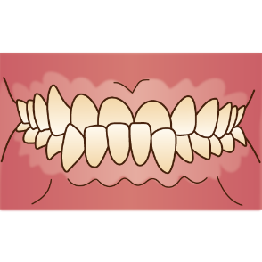 前歯のかみ合わせが逆（反対咬合、下顎前突）