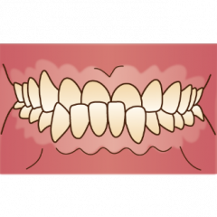 下顎前突（下の前歯が上の前歯より前方に位置し、かんでいる状態）